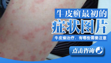 银屑病女患者吃什么好